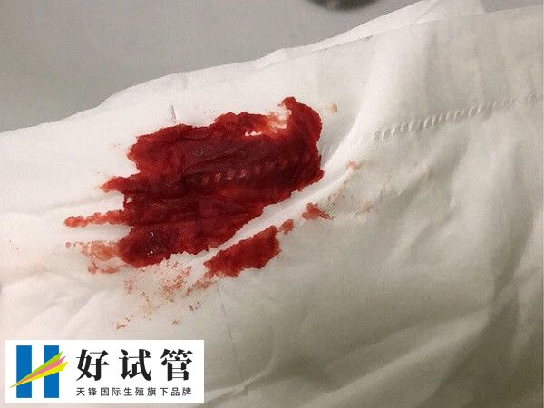 试管移植后出血多可能是宫外孕