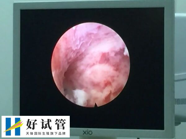 宫腔镜可以确诊宫腔疾病
