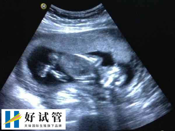 不做宫腔镜不影响移植