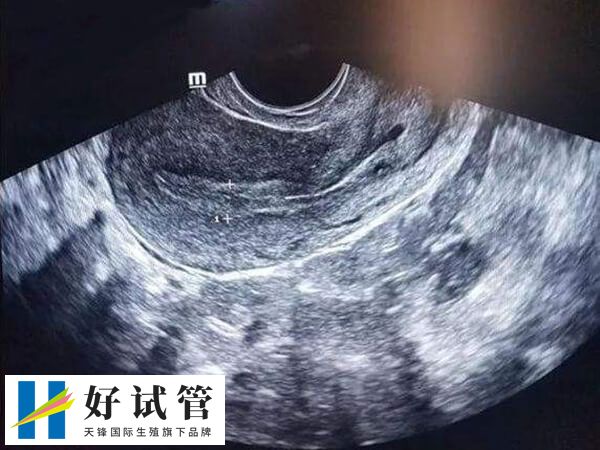 宫颈息肉通常是由缓慢炎症引起的